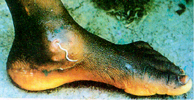 Guinea Worm